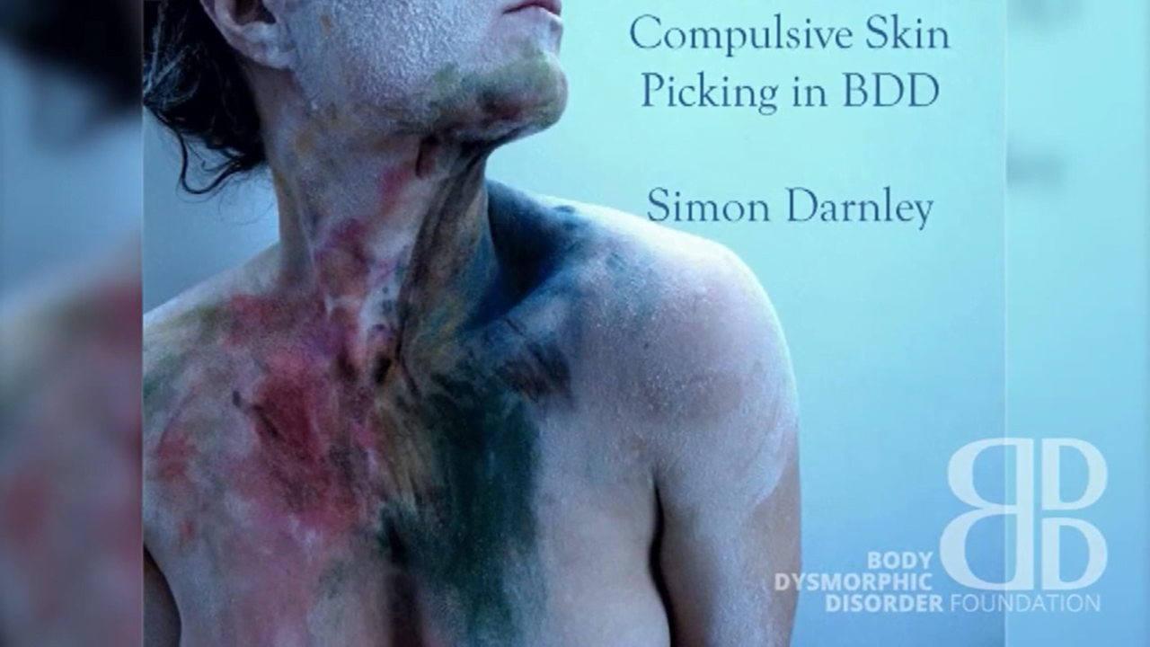 Compulsive Skin Picking